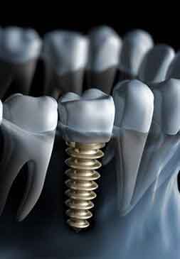Dental implants (dental implants)