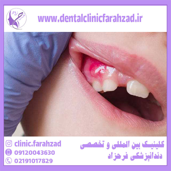 درمان عفونت ریشه دندان و لثه