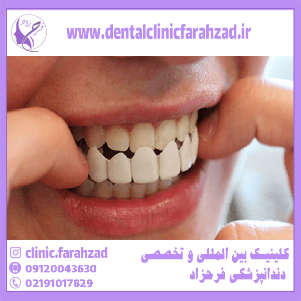 پروتزهای دندانی و ایمپلنت