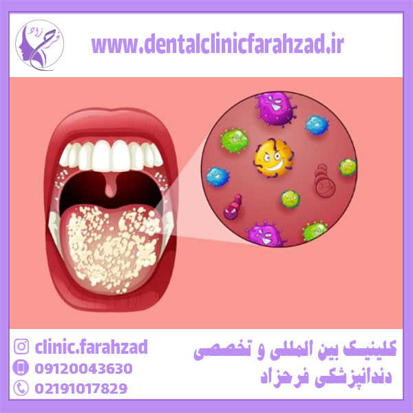 مزایای پروبیوتیک های دندانی
