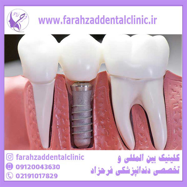 روش های کاشت دندان چیست؟