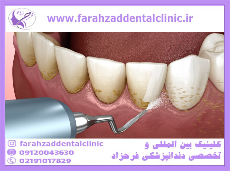 جرم گیری دندان و کاهش پلاک دندان ها